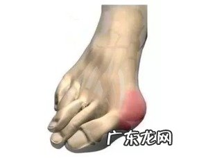 脚拇外翻手术费用 脚的大拇指外翻怎么治疗图片