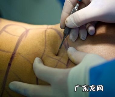 大臂抽脂有什么副作用 抽脂有什么风险和后遗症