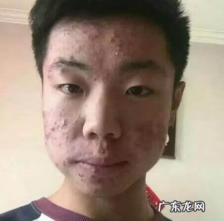 青春期痘痘一般几年 青春期痤疮一般到什么年龄结束