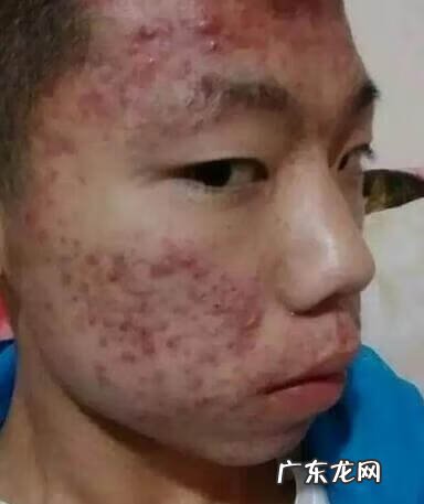 青春期痘痘一般几年 青春期痤疮一般到什么年龄结束