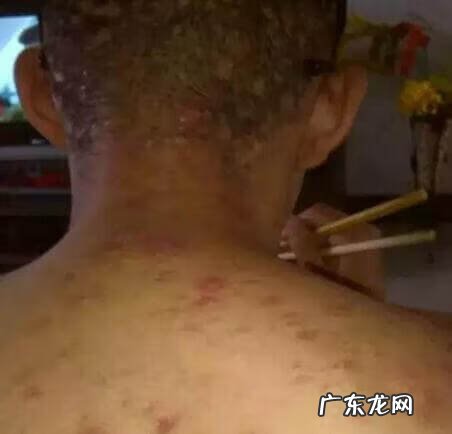 青春期痘痘一般几年 青春期痤疮一般到什么年龄结束