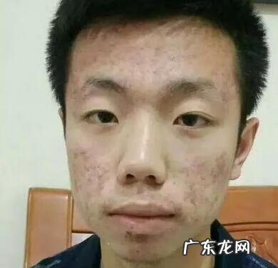 青春期痘痘一般几年 青春期痤疮一般到什么年龄结束