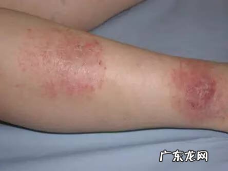 皮炎湿疹 湿疹性皮炎图片