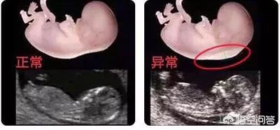 大排畸以后,为什么还要再做至少2次B超?真的重要吗?