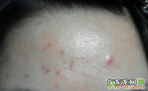 额头长痘是什么情况 额头上长痘是因为什么