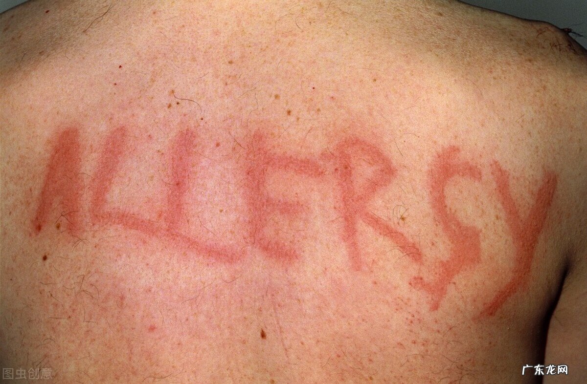 皮肤划痕症需要治疗吗 皮肤划痕症怎么治疗?