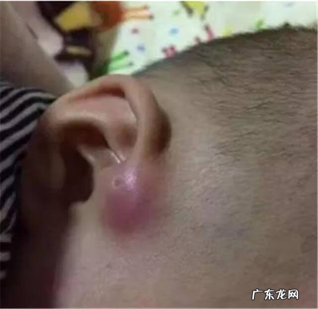 耳朵后面有两个小坑 耳朵上有小坑好不好