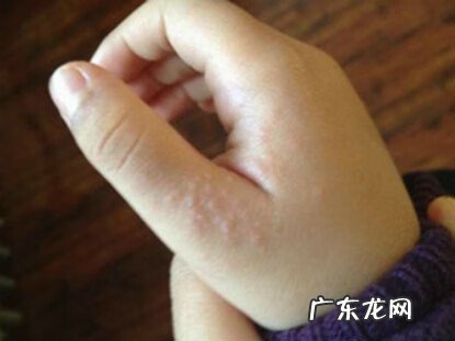皮肤过敏怎么办才最有效 皮肤过敏怎么治疗好