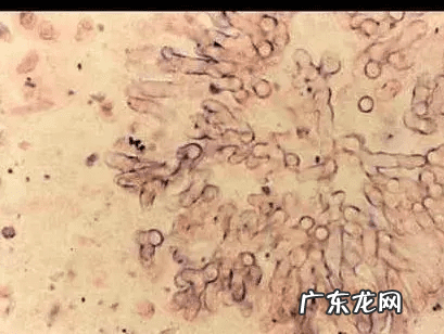 霉菌性阴炎怎么得病的 细菌性和霉菌性阴炎怎么得来的