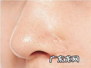 怎么样去除黑头粉刺 如何去除黑头和粉刺痘痘印