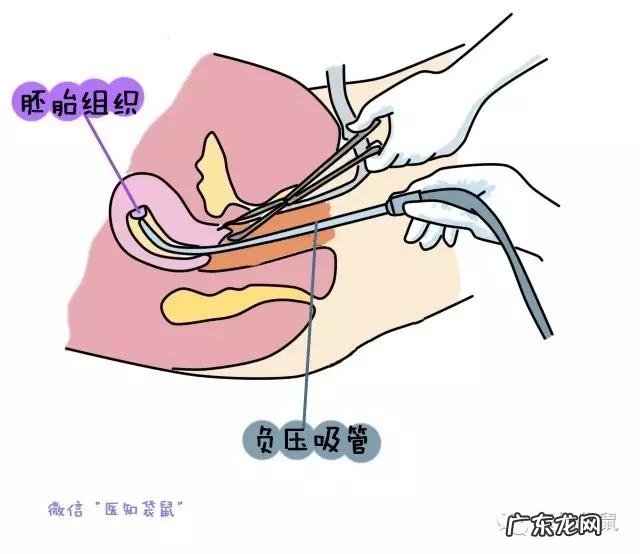 刨腹产四年后又怀孕了，药流和人流哪个好？