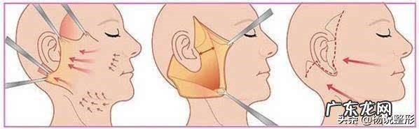 如何进行面部提升?