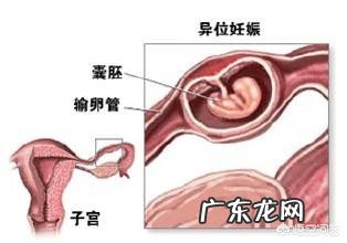 孕期出血是怎么回事?如何避免出血找上门?