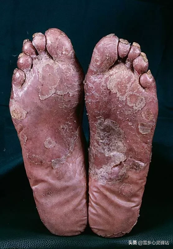 天天看到艾滋病新闻看到血都怕了,什么时候有能治好艾滋病的药?