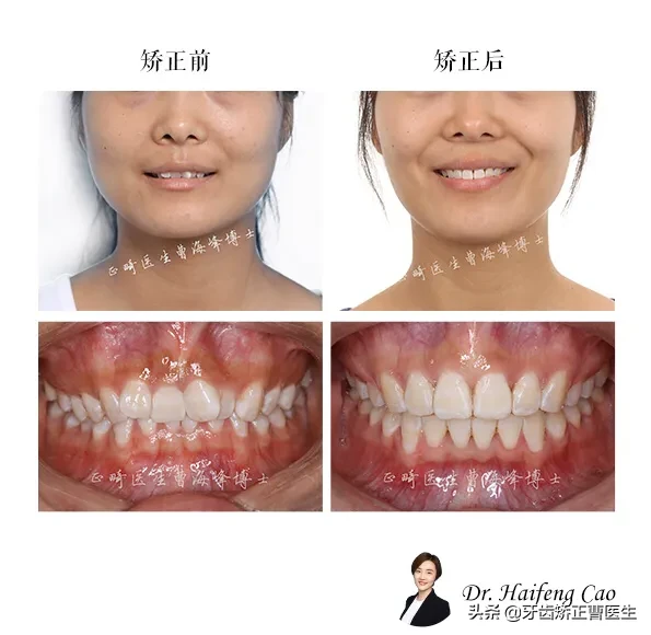 大门牙不齐,很自卑怎么办?