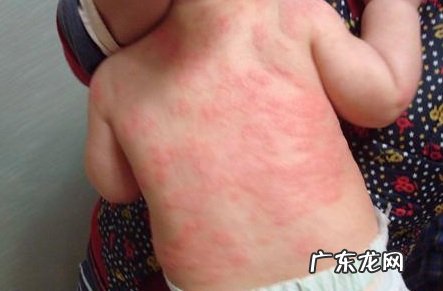 如何区别湿疹和热痱?