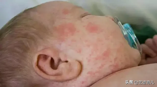 如何区别湿疹和热痱？