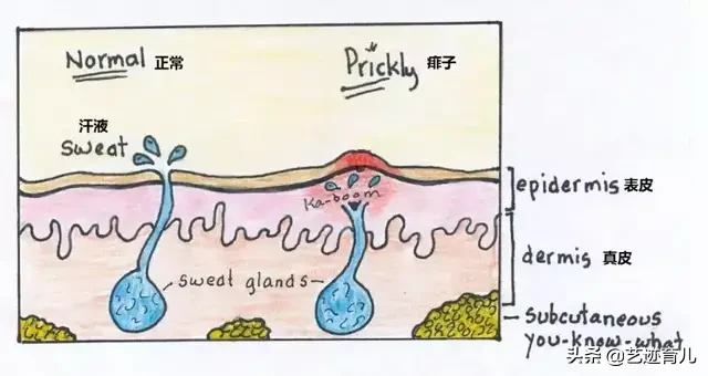 如何区别湿疹和热痱？