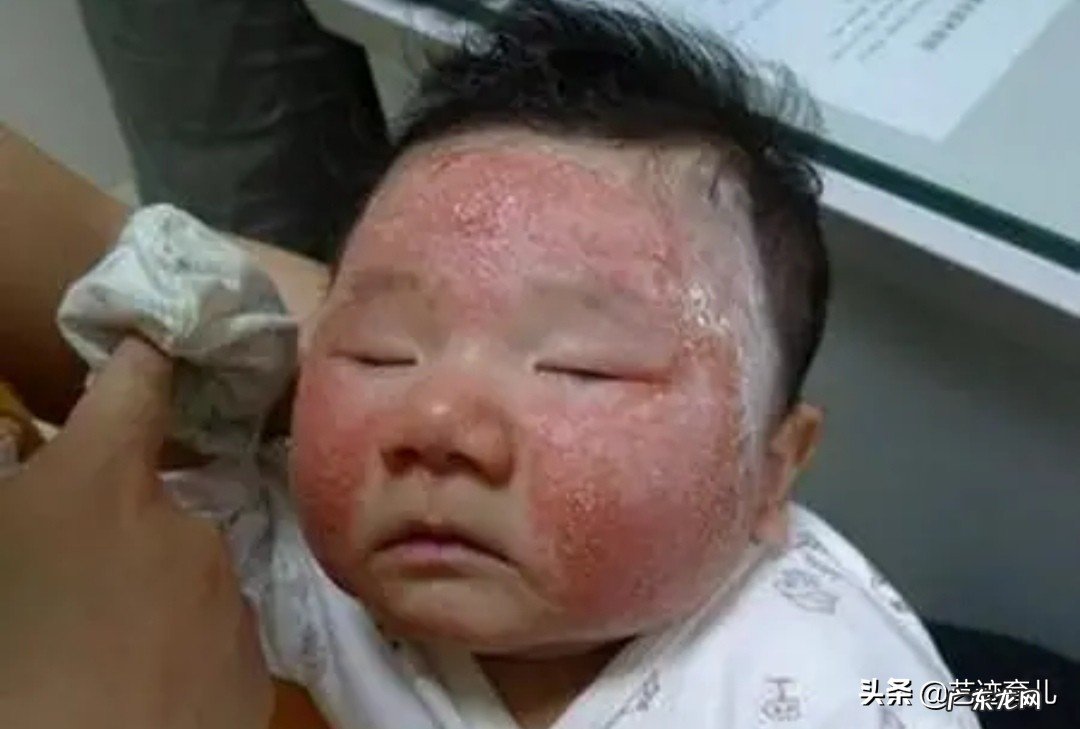 如何区别湿疹和热痱？