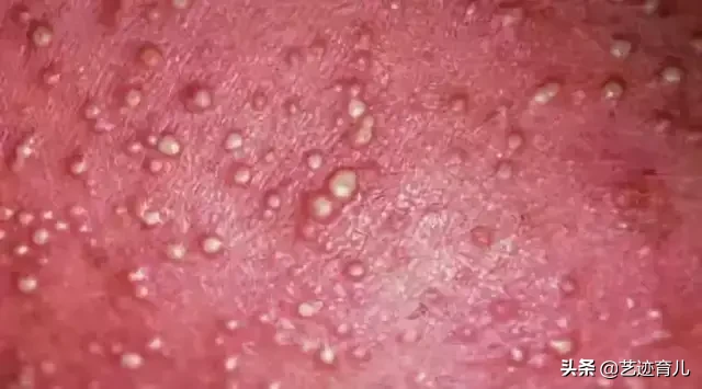 如何区别湿疹和热痱？