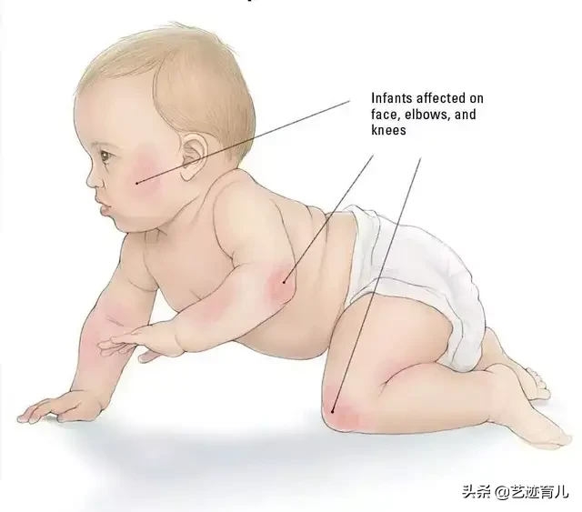 如何区别湿疹和热痱？