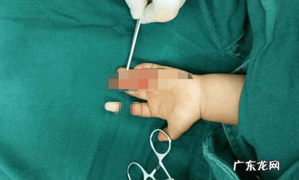 右手食指一节半人损几级 右手食指断了一节影响大吗