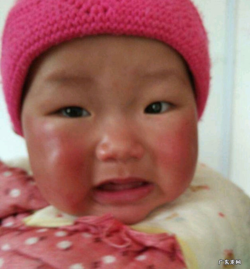 冬天来了如何防治冻疮?