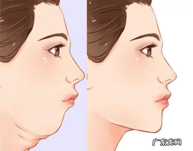 双下巴如何处理 长双下巴怎么办?
