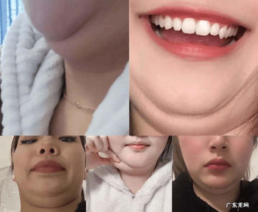 双下巴如何处理 长双下巴怎么办?