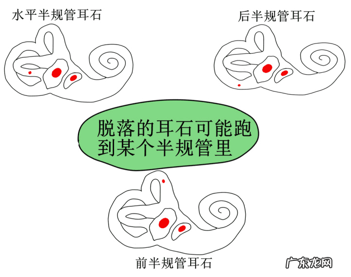 耳石症的原因 耳石症是怎么造成的