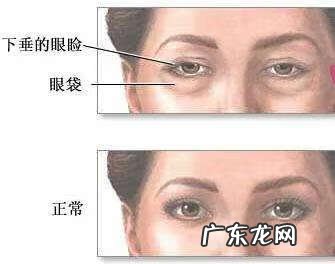 孩子有下眼袋 眼袋大对子女好吗?