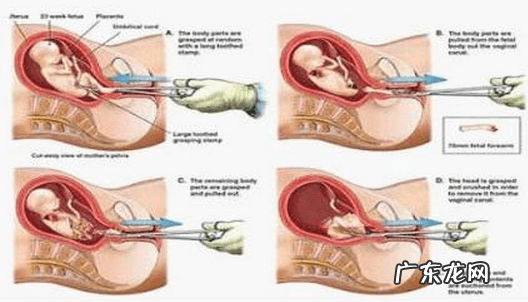 终止妊娠证明怎么开 终止妊娠的几种方法