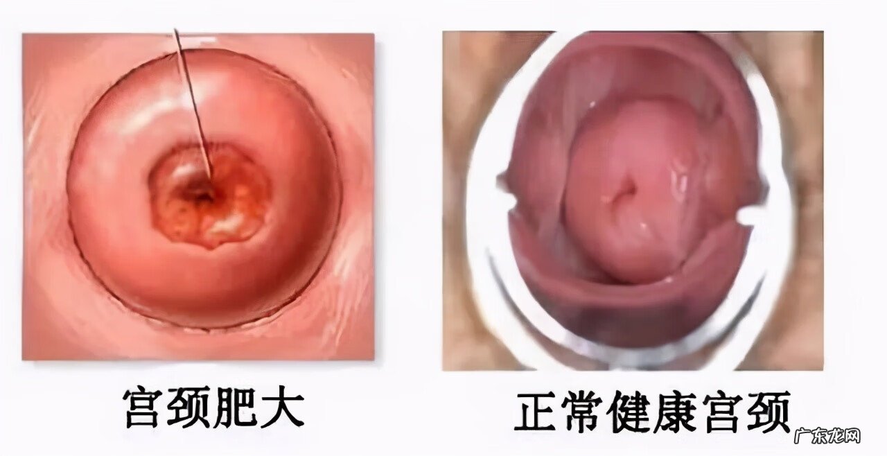 怎么分清自己哪种妇科炎症 慢性妇科炎症严重吗