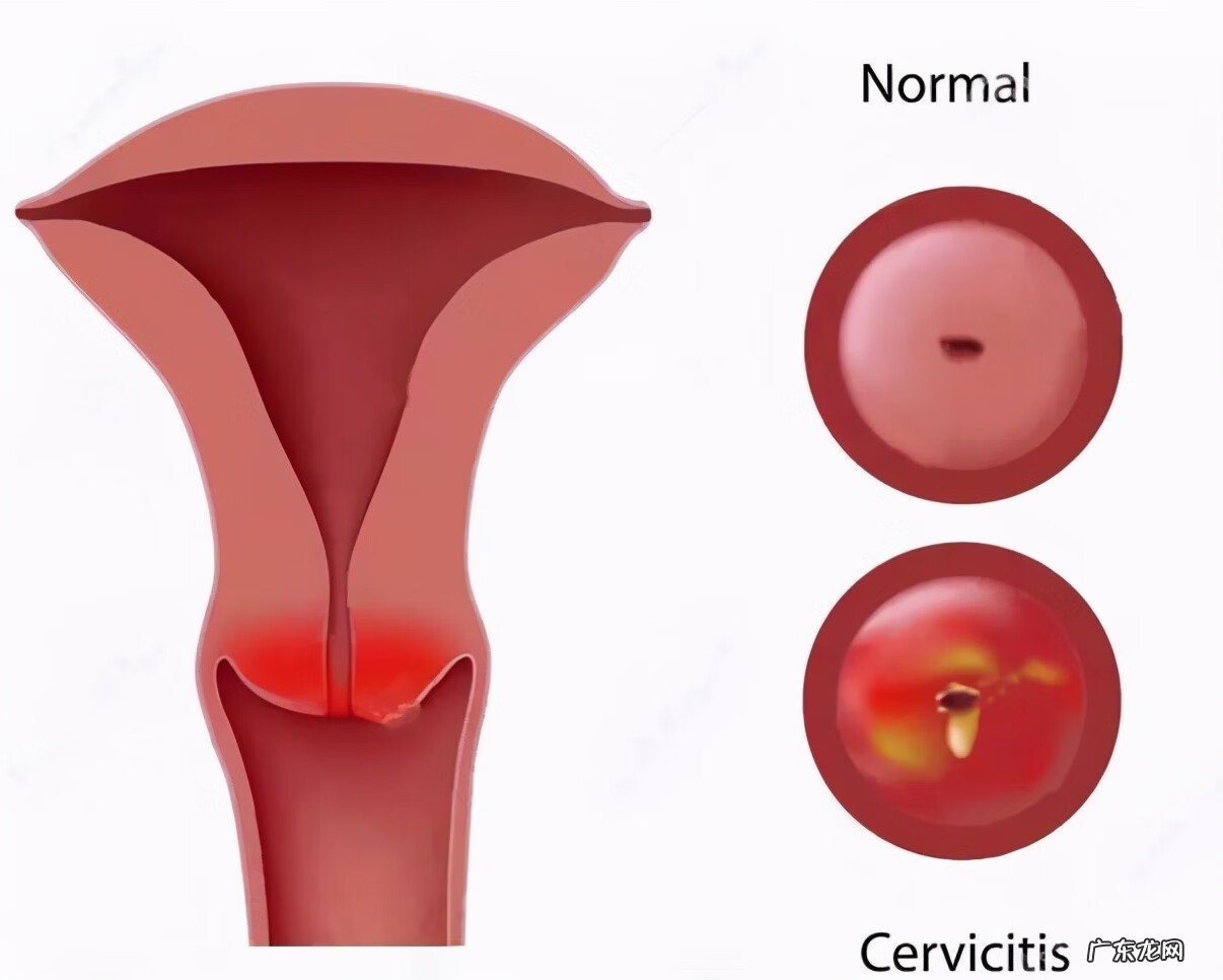 怎么分清自己哪种妇科炎症 慢性妇科炎症严重吗