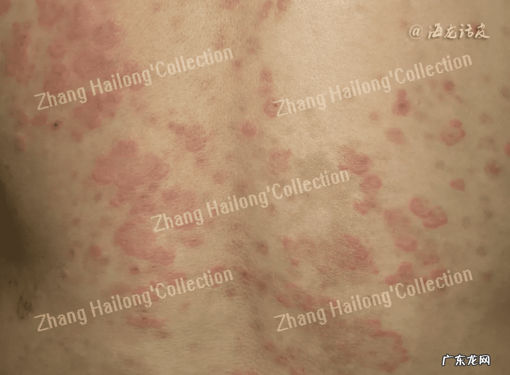 过敏源怎么做检查 过敏源检测有必要查吗