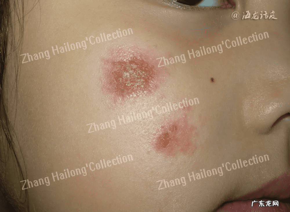 过敏源怎么做检查 过敏源检测有必要查吗