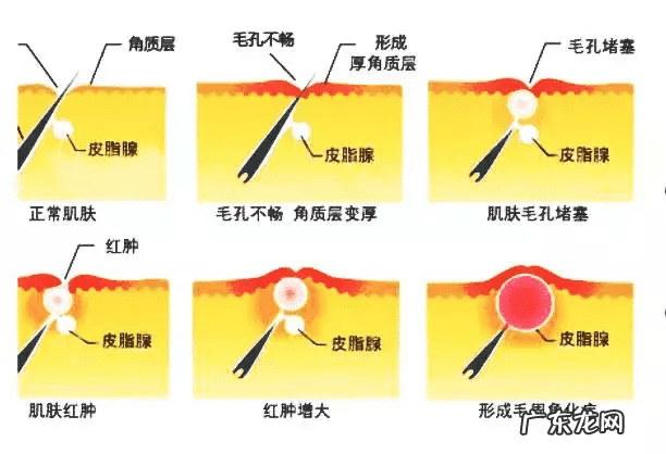 怎么治疗鸡皮肤最有效 鸡皮肤怎么治疗