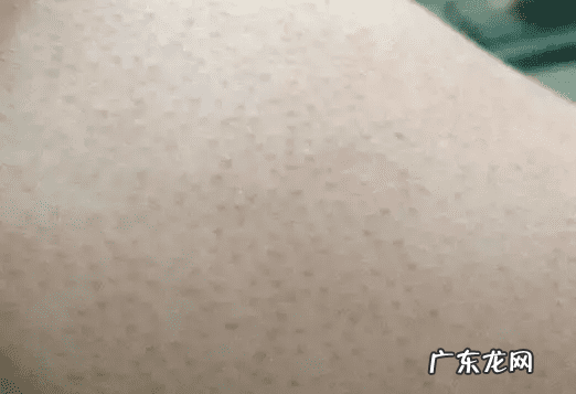 怎么治疗鸡皮肤最有效 鸡皮肤怎么治疗