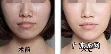 超光子嫩肤和超皮秒区别 光子嫩肤图片对比效果