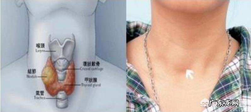 #秋补#如何通过饮食调理甲状腺结节?