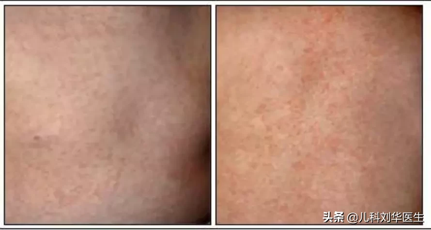 幼儿急疹最简单判断方法 幼儿急疹图片