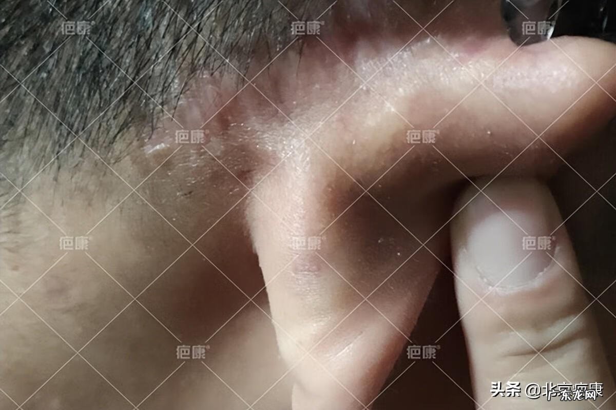 左额头有疤痕面相 头上有疤的图片