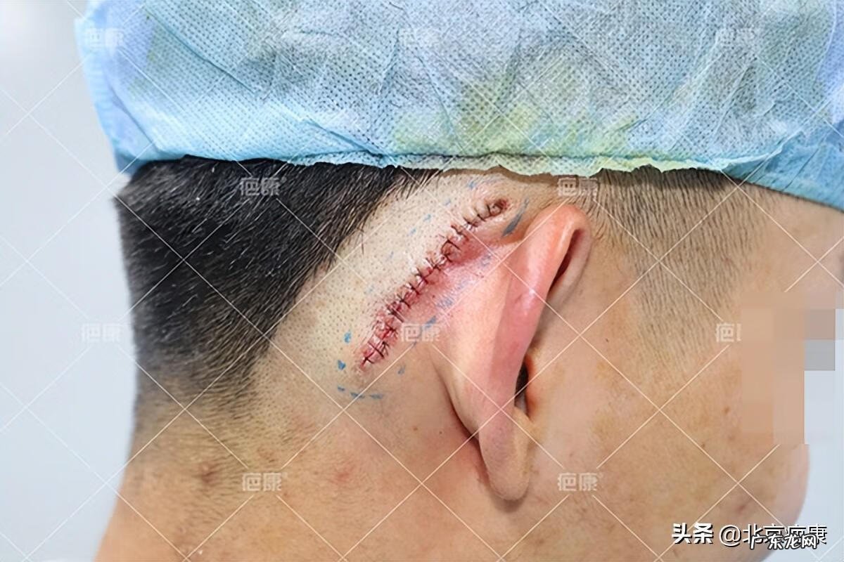 左额头有疤痕面相 头上有疤的图片