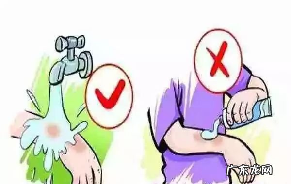 小儿烧伤特点 小儿烧伤