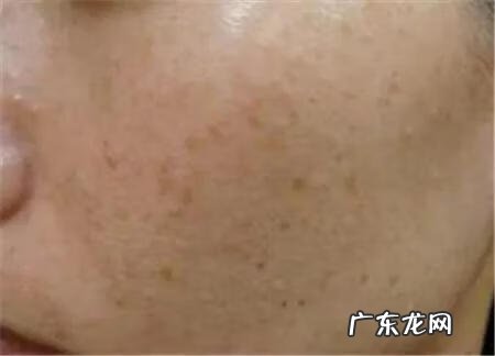 面部长斑图片大全