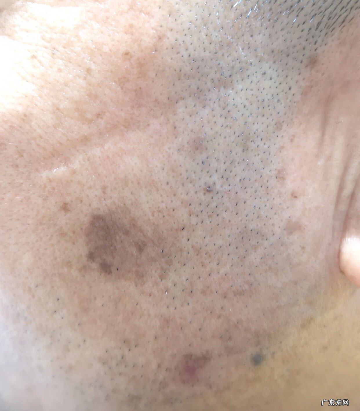 面部长斑图片大全