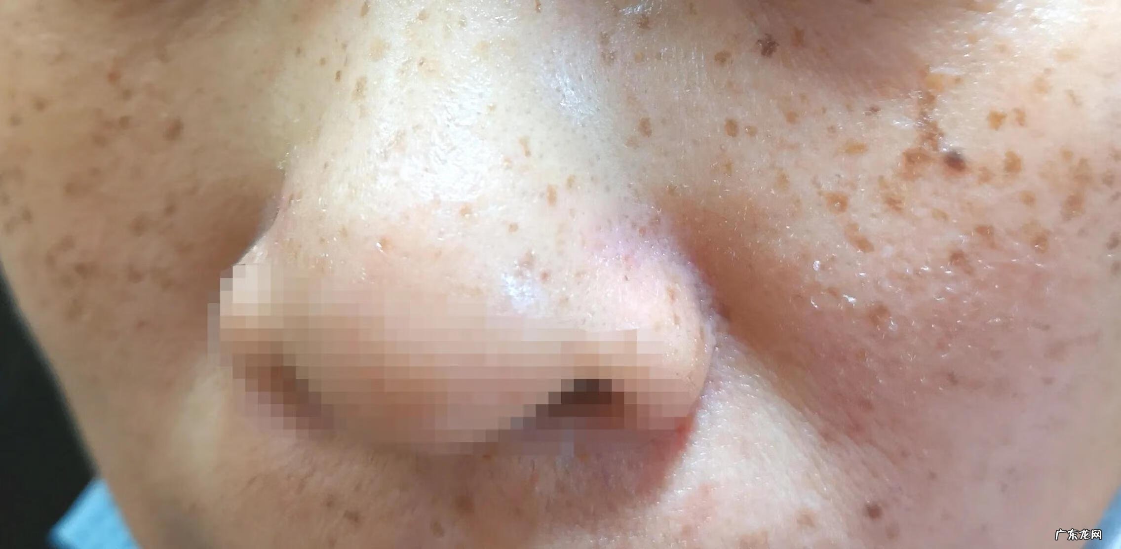 面部长斑图片大全