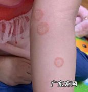 猫藓传染给人的症状 猫藓传染给人的症状图表图片