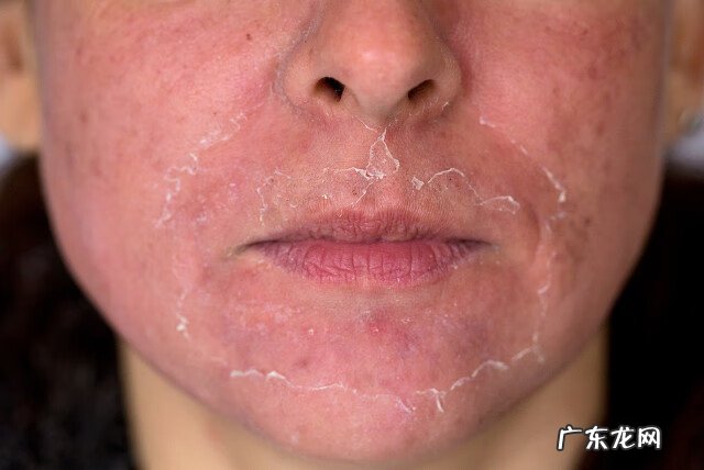 治疗红血丝最有效的方法 脸上红血丝的治疗