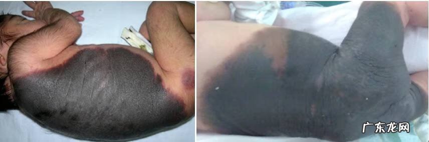 儿童脸上长湿疹图片 儿童湿疹的症状图片